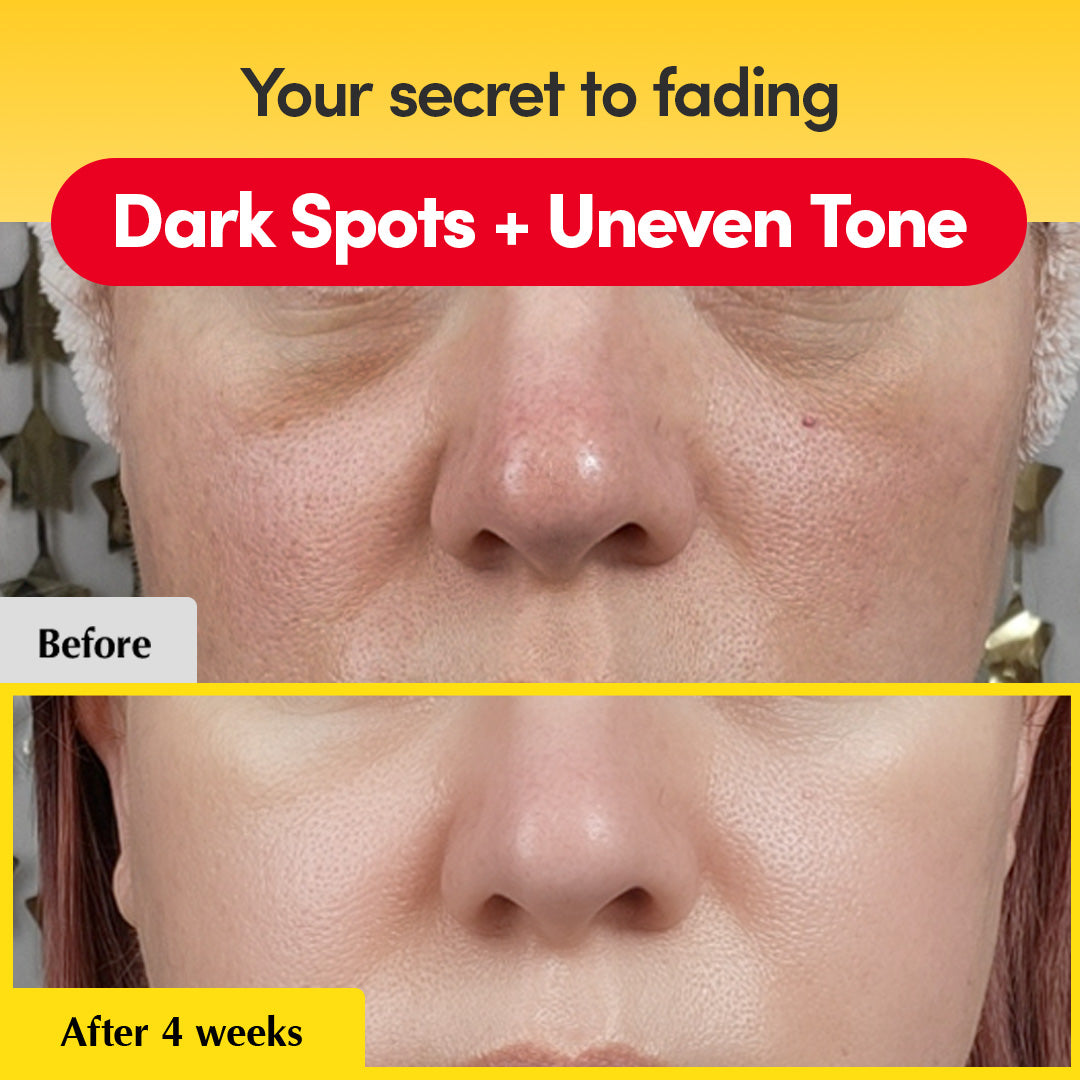 [Amazon No.1 ] Vitamin Illuminating Dark Spot Serum